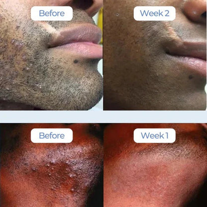 Smoothing Solution Ingrown Hair Treatment